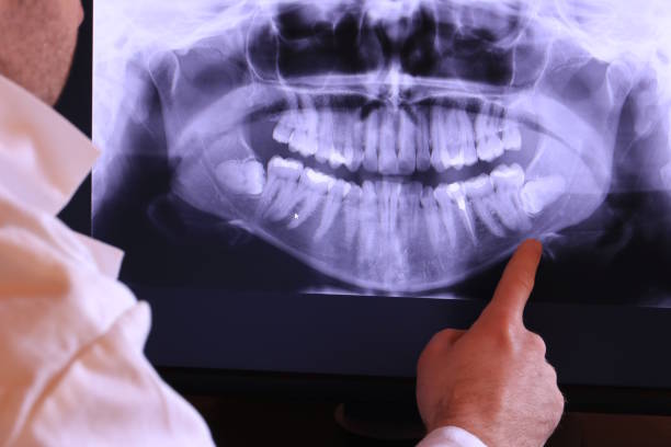 Best Emergency Wisdom Teeth Removal in Plano, IL